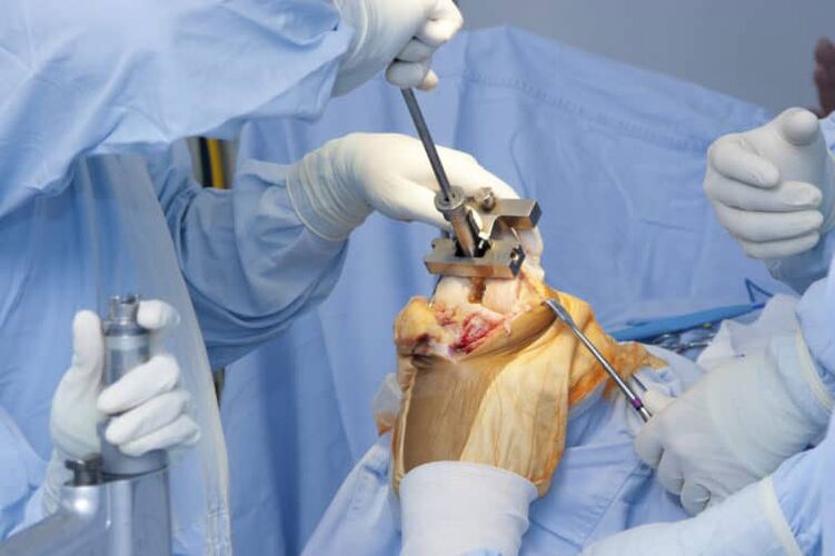 операція при артрозі колінного суглоба