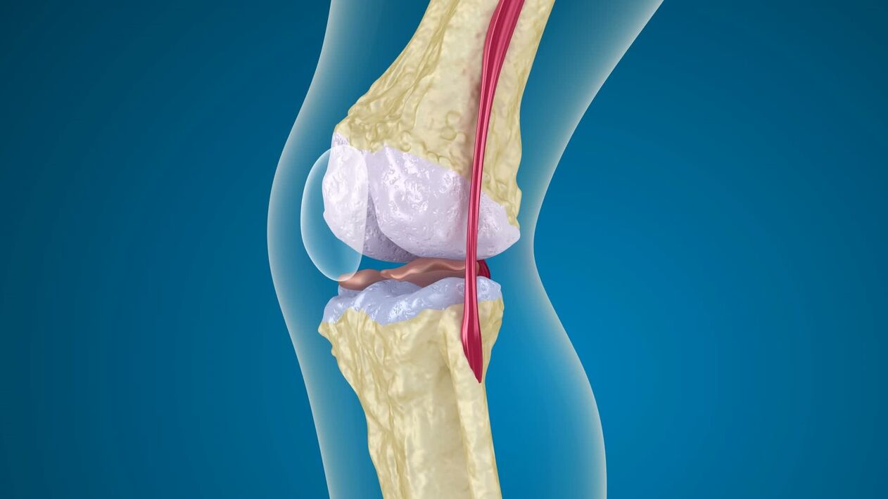 руйнування колінного суглоба при артрозі