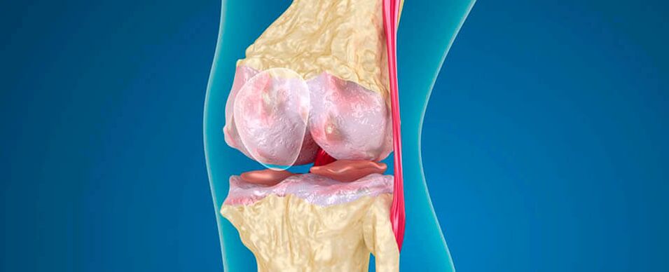 артроз колінного суглоба як причина болю