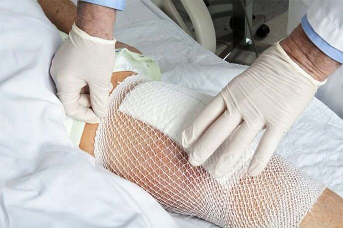 Лікувальний компрес при артрозі колінного суглоба