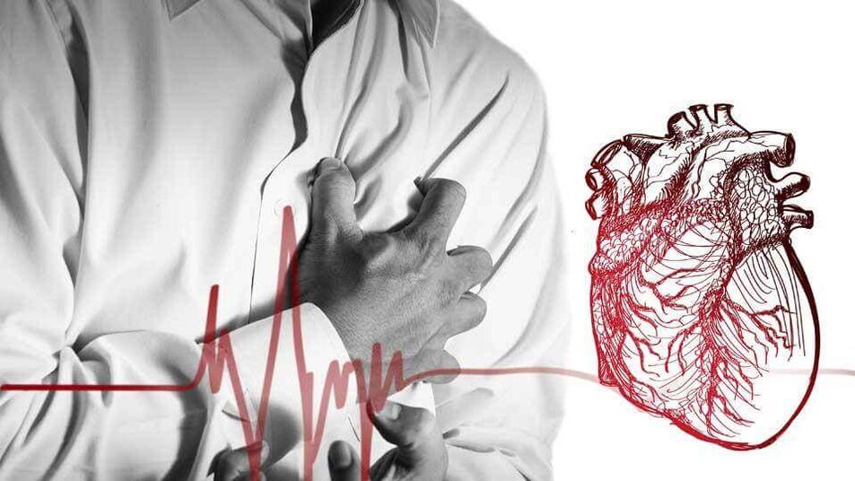 Внаслідок порушеного серцевого ритму при грудному остеохондрозі може розвинутись екстрасистолія