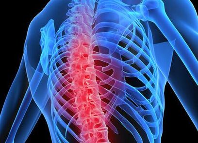 остеохондроз грудного відділу хребта