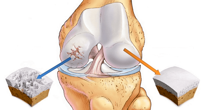 здоровий хрящ та хрящ уражений артрозом