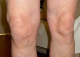 симптоматика колінного суглоба